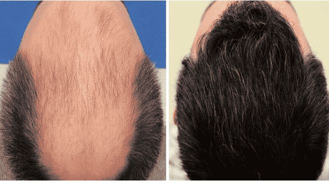 زرع الشعر في شيراز - شيدرخ تراڤل